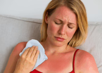 Napégés kezelése – Gyors megoldások a leégett bőr megnyugtatására